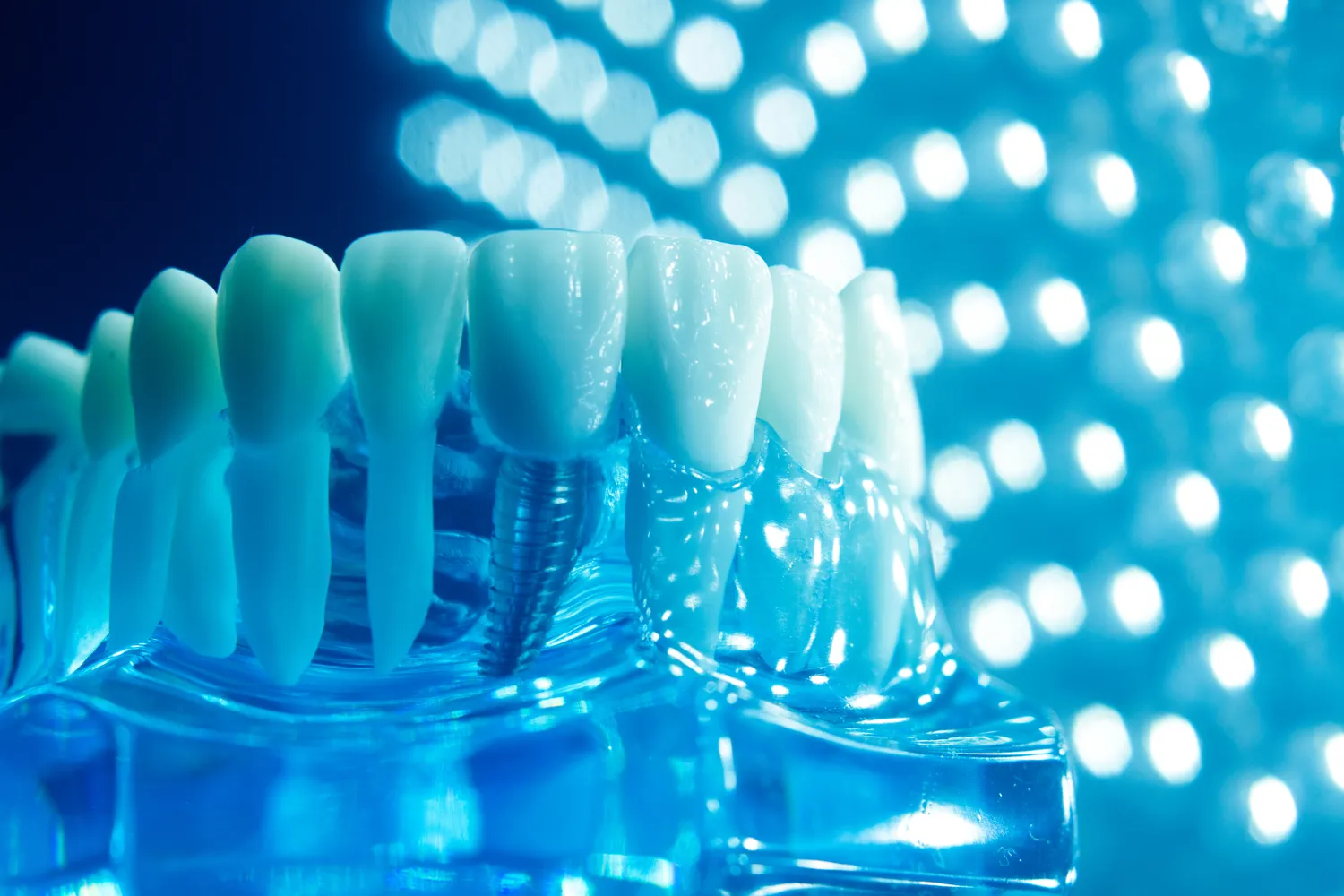 Implanty w jeden dzień Koszalin